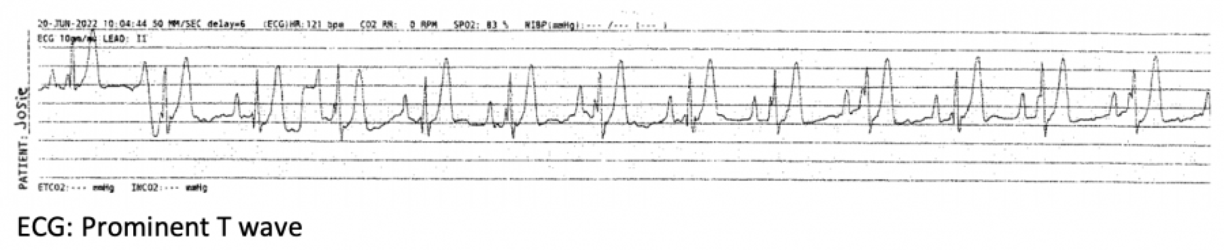 ECG